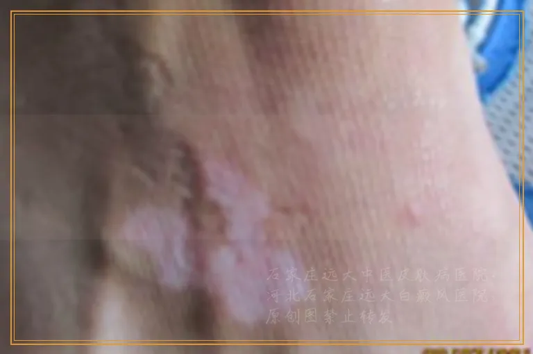 手背白癜风是不是比脸部白斑好的慢