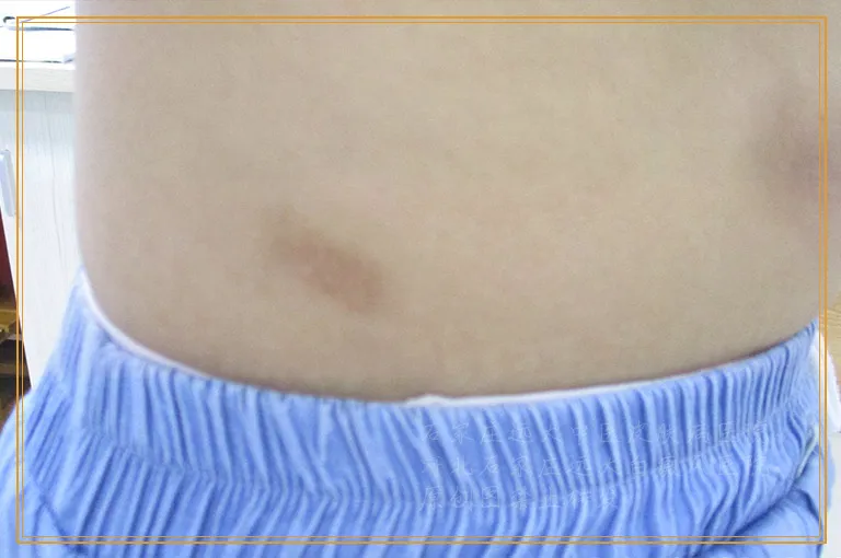 手掌心照伍德灯显示一块白怎么回事