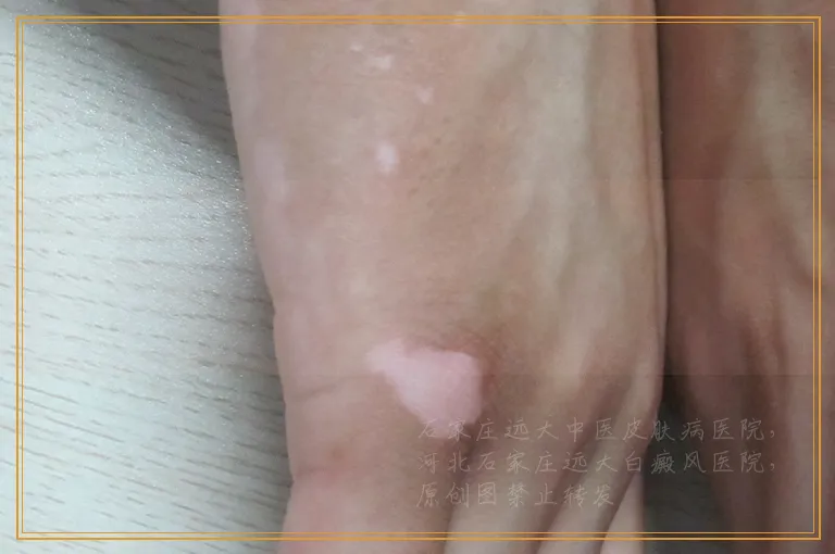 身上长有白斑慢慢变多是不是白癜风