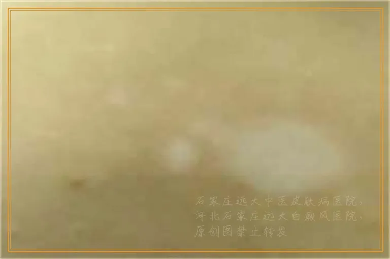 伍德灯检测脸部白斑准确率有多大