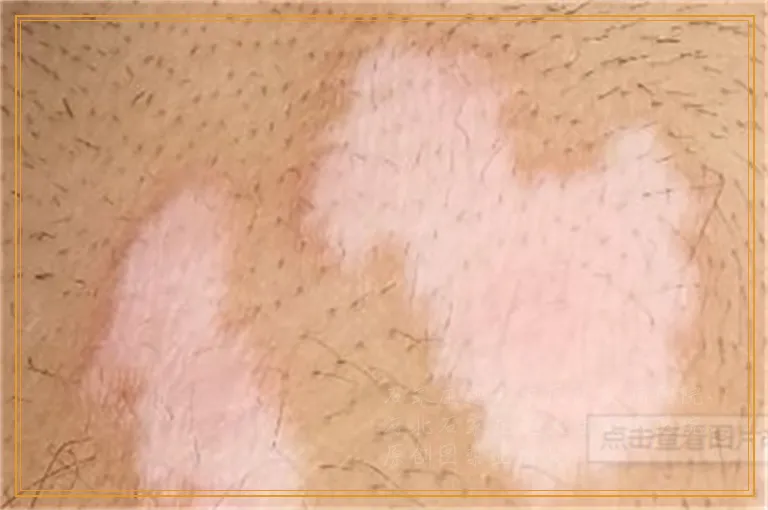 白斑医院检查没确诊还在扩大怎么办