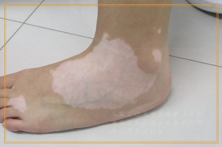 白癜风长在手上是不是治不好