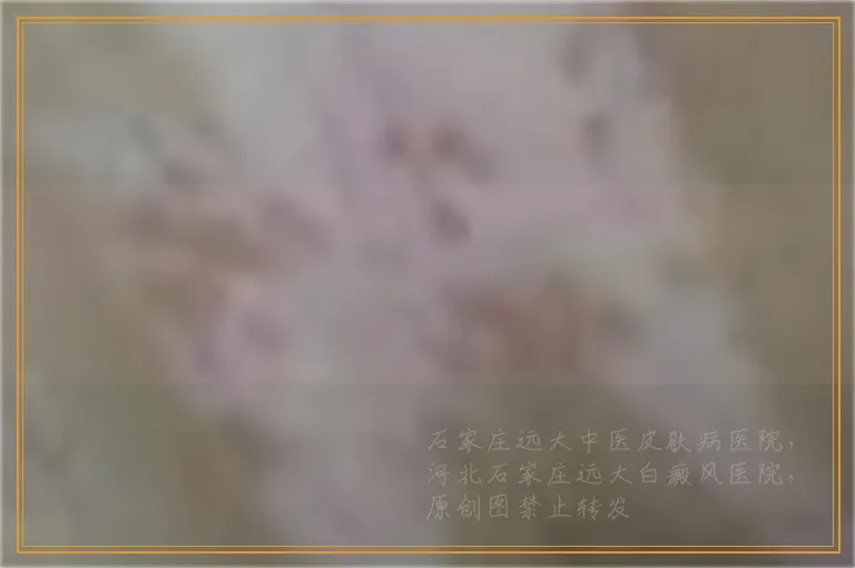 白斑照伍德灯检查为阳性是白癜风吗
