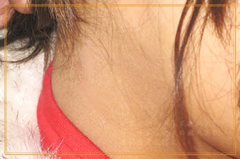 皮肤ct检查白斑一次需要多少钱