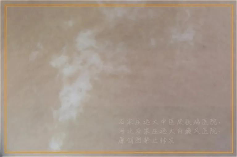 皮肤影像检测和伍德灯是一回事吗