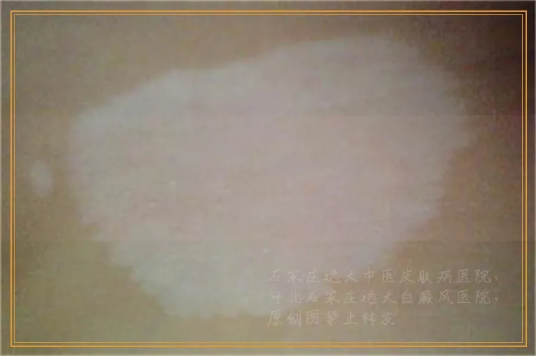 伍德灯检查纯白无荧光还是白癜风吗