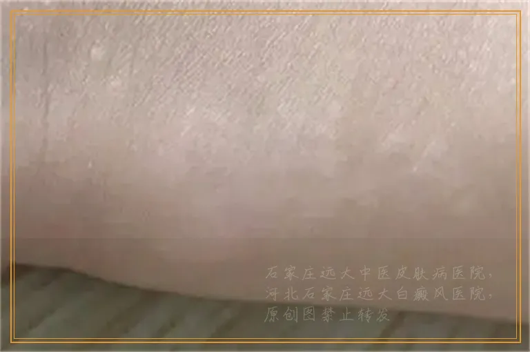 白癜风早期在伍德灯下的图片