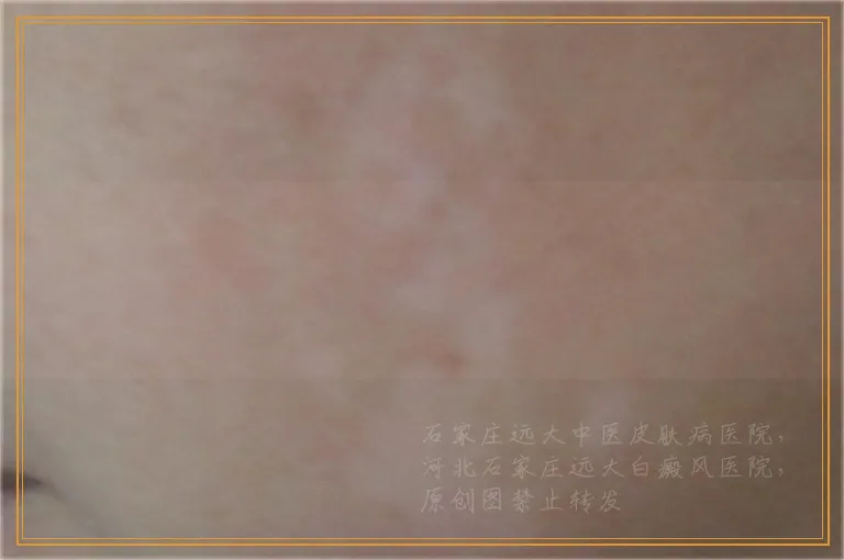 皮肤CT和伍德灯哪个检查白斑准