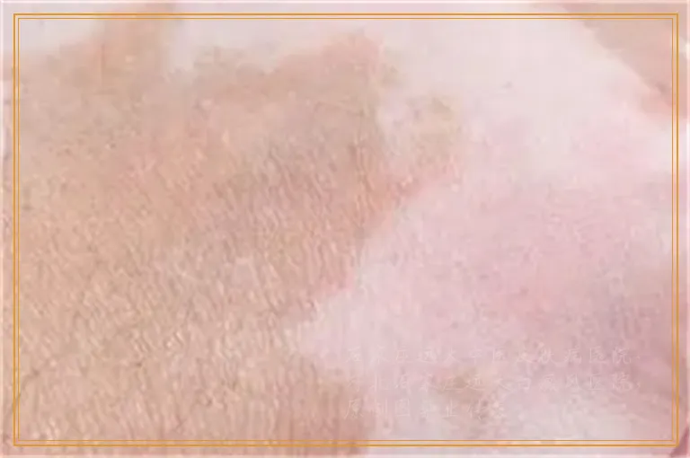 下巴上白了一小片是不是白癜风