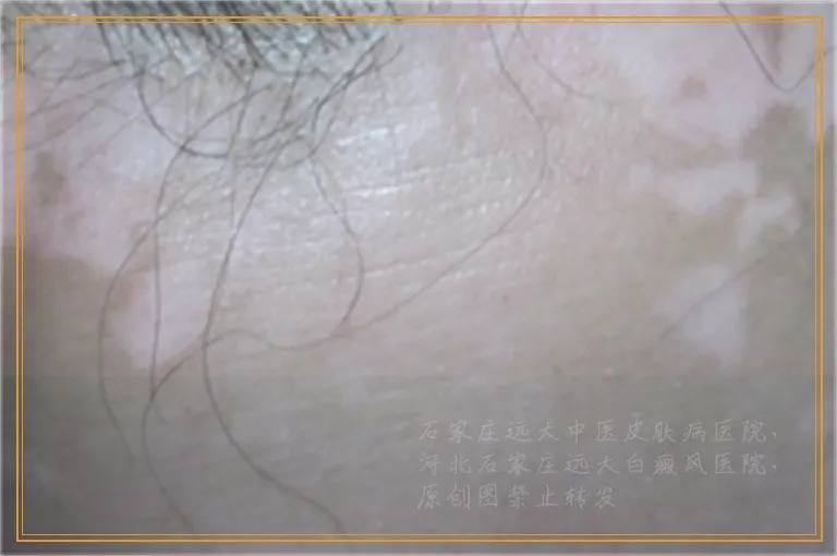 伍德灯是不是就能判断出白癜风