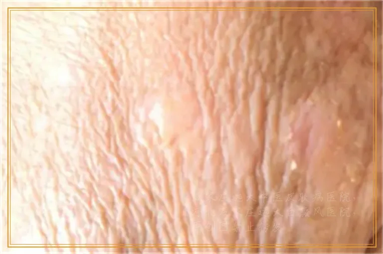 大腿长白点照ct能确诊是白癜风吗