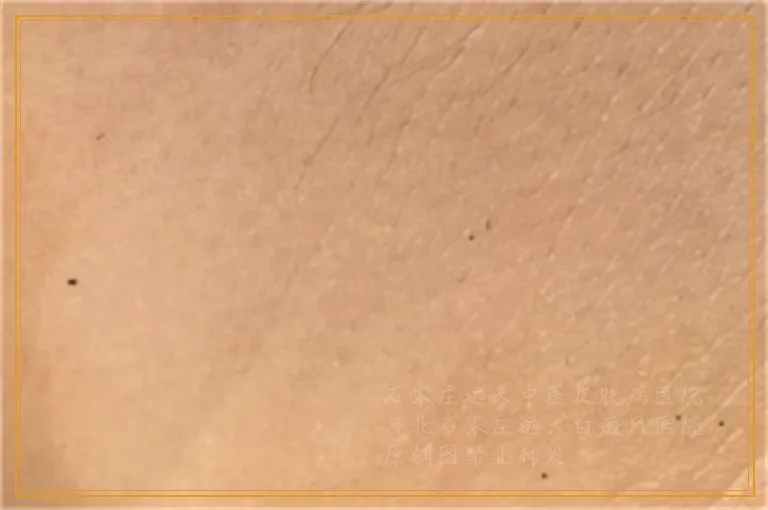 皮肤上有块白斑诊断白斑医院在哪