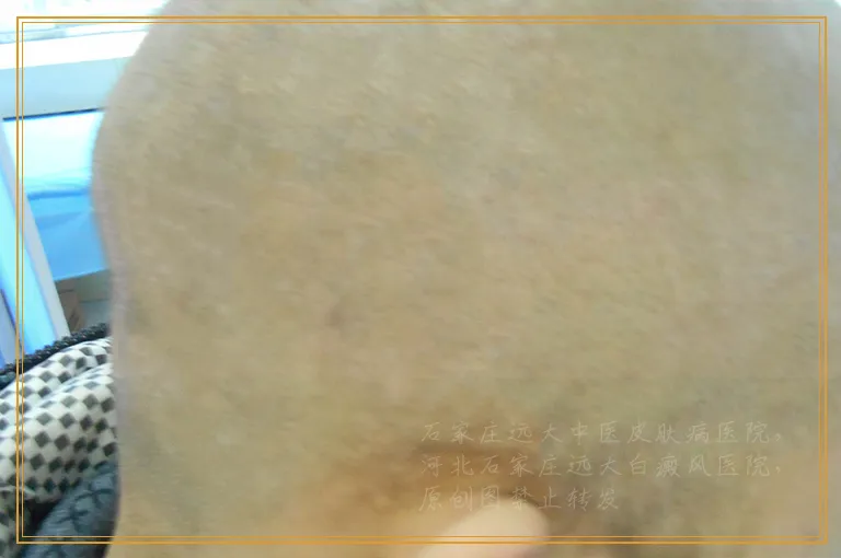 额头上的白斑照伍德灯呈荧白光是白癜风吗