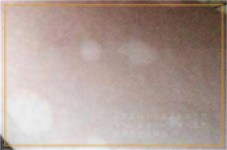 肛周泛白如何确定是不是白癜风