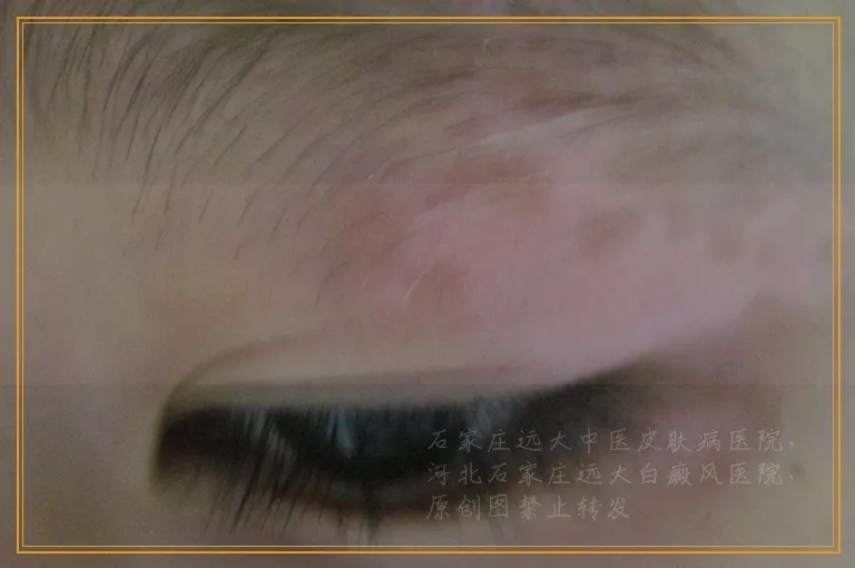 确诊白癜风3个月越来越多怎么办