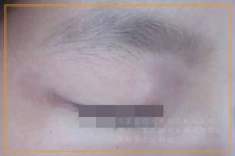 后背密密麻麻的小白斑是不是白癜风