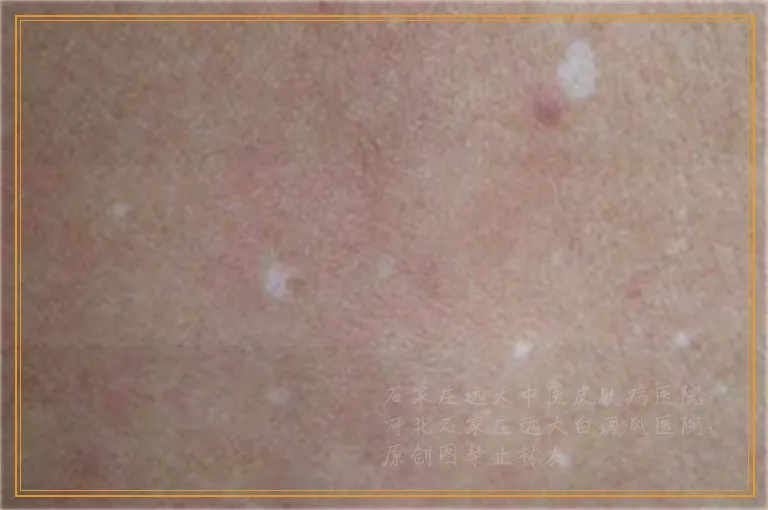 伍德灯检查出亮白色就是白癜风吗