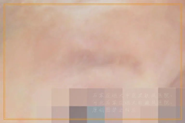 白癜风在伍德灯下是什么颜色的