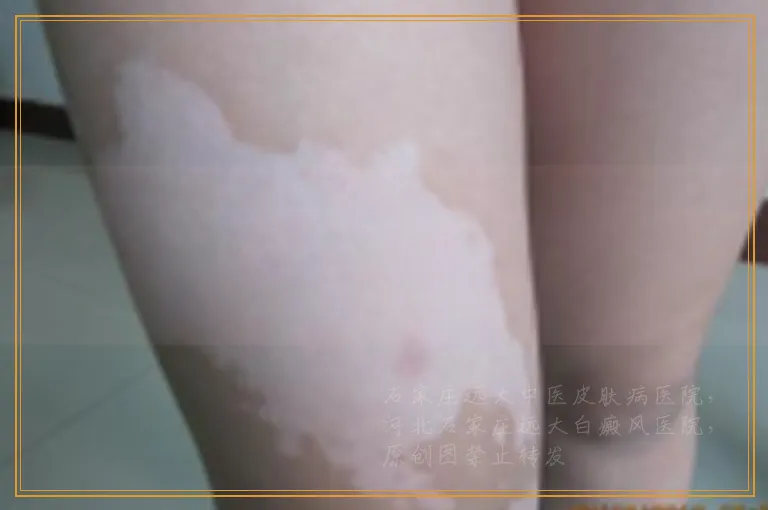 白斑照wood灯下暗白色荧光是什么意思