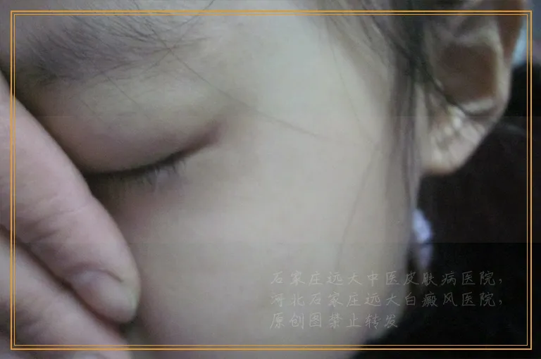 手指白癜风照光后是不是好转特别慢