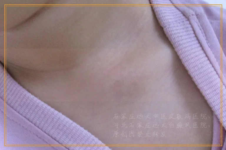 无名指上有几片白斑用ct能诊断吗