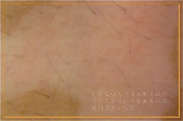 白斑照伍德灯显瓷白色荧光是白癜风吗