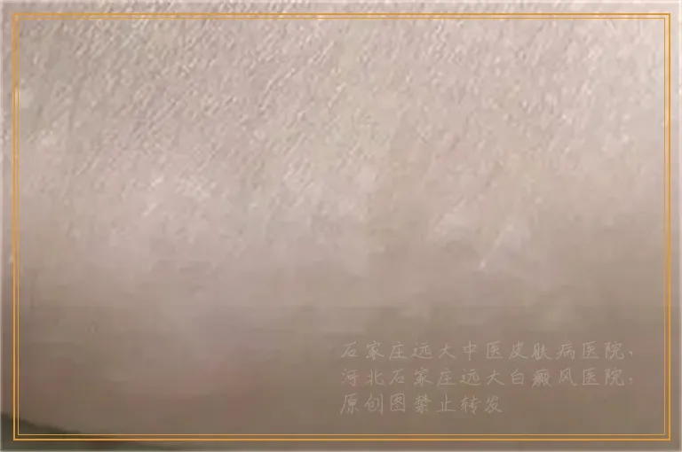 眼角长块白斑是不是白癜风怎么判断