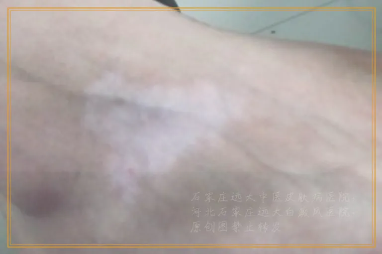 照伍德灯可以看出来是白癜风吗