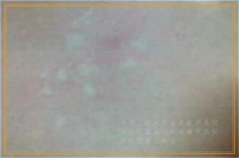 白斑揉搓以后变红是不是白癜风