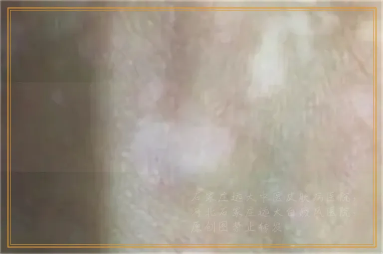 四肢对称都有块白斑是不是白癜风