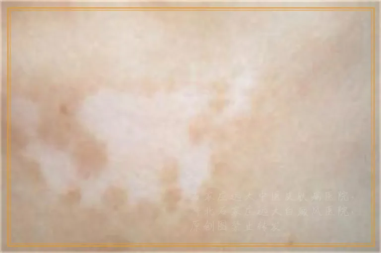 伍德灯看不到白癜风了算好了吗