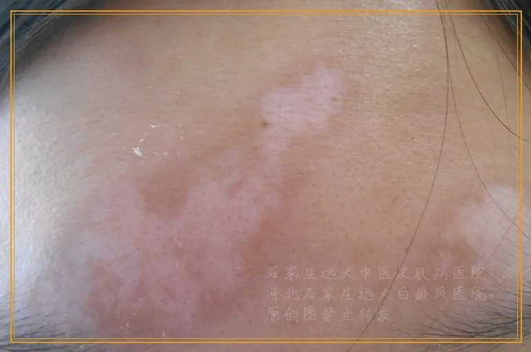 伍德灯照出来是瓷白色能断定是白癜风吗