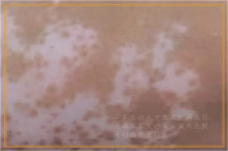 胳膊上有白块慢慢变大是不是白癜风