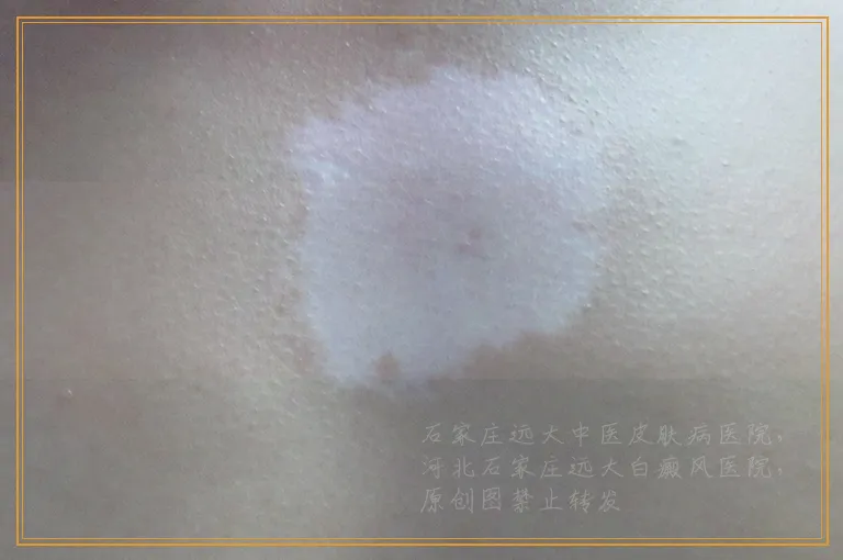 白斑在伍德灯下显示轻微白色是白癜风吗