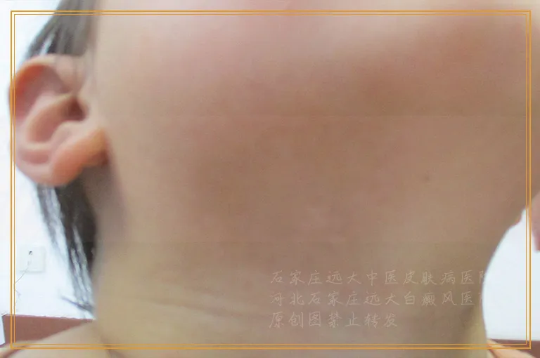 胳膊上有几块白点是不是白癜风