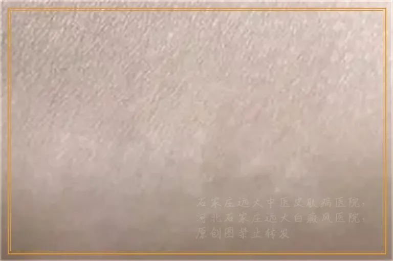 皮肤ct检查白癜风准确率高不高