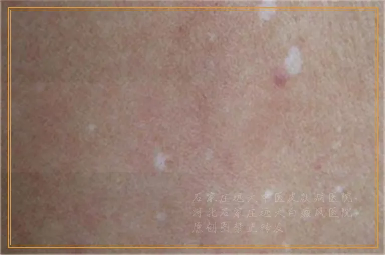 伍德灯检查白癜风的报告图片