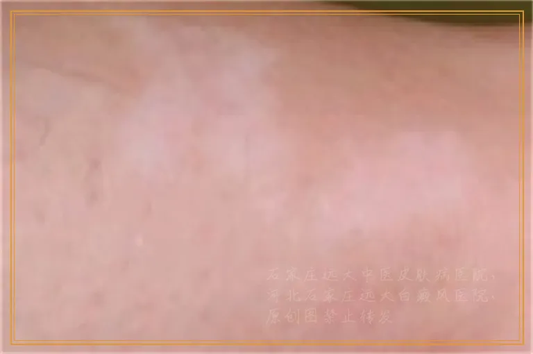 下巴长了一个白点像是白癜风怎么确诊