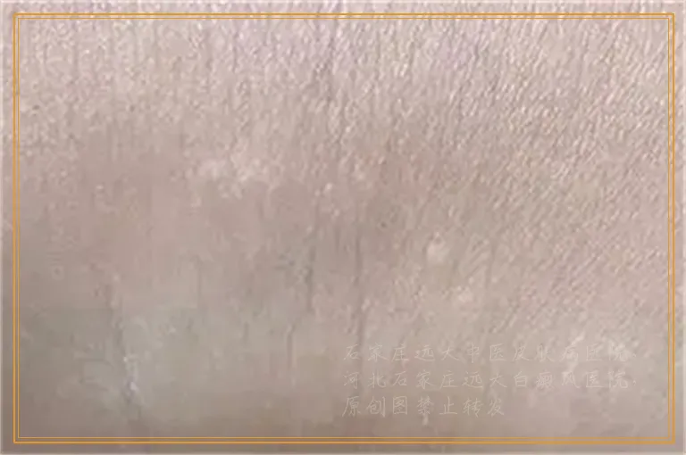 美国三维皮肤CT检查白癜风多少钱