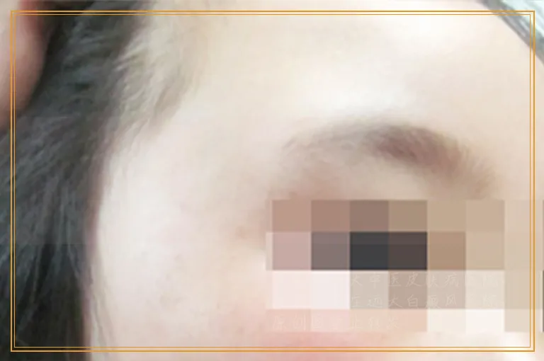 腰上屁股上都有白块是不是白癜风