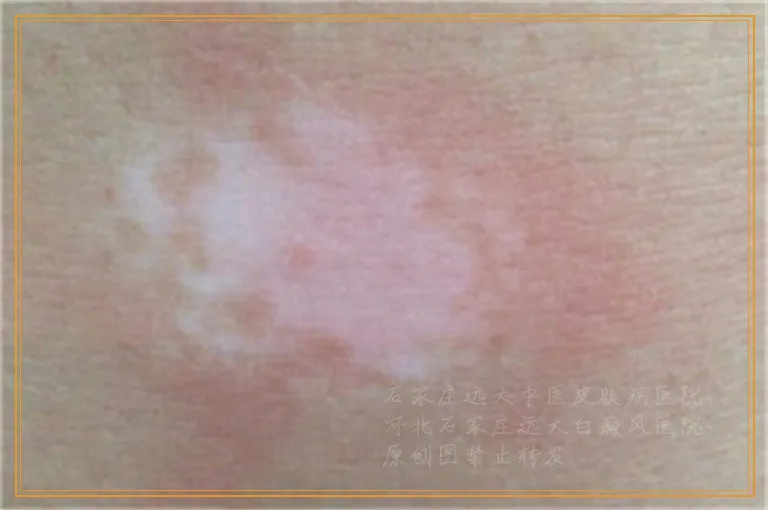 白癜风治疗一个月没啥变化是不是不好治