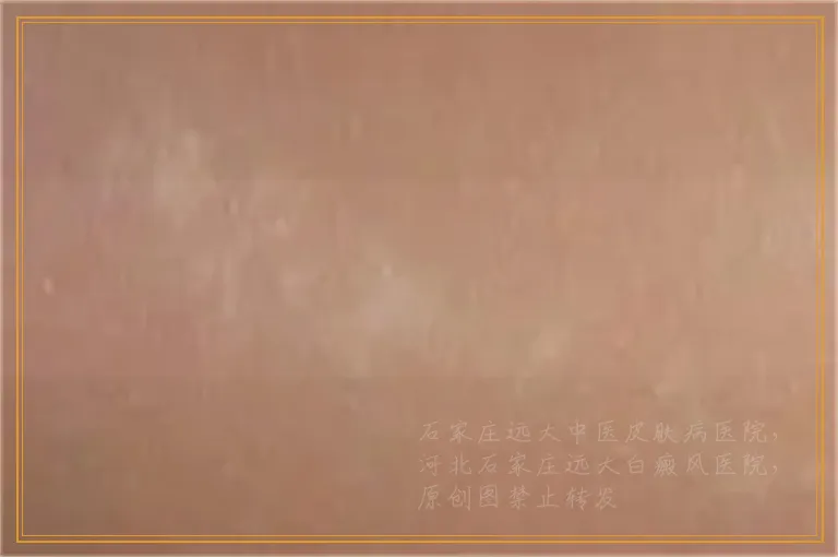 脚指白了一大块是不是白癜风