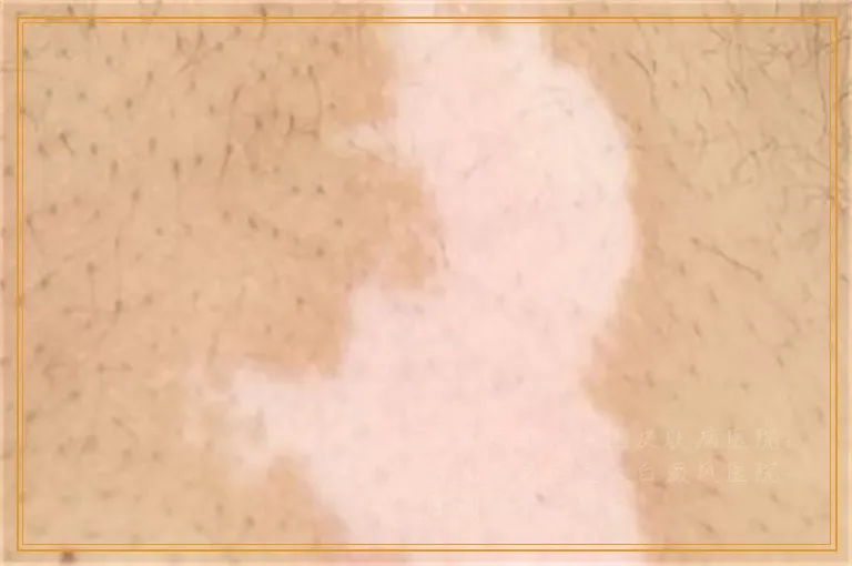 伍德灯阳性就是白癜风吗