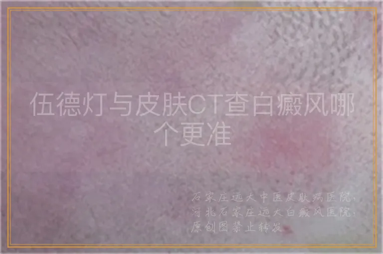伍德灯与皮肤CT查白癜风哪个更准