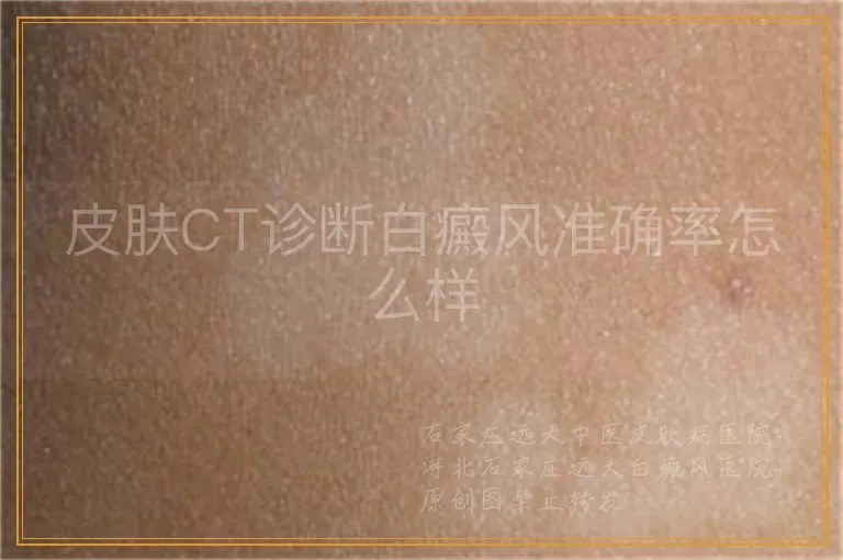 皮肤CT诊断白癜风准确率怎么样