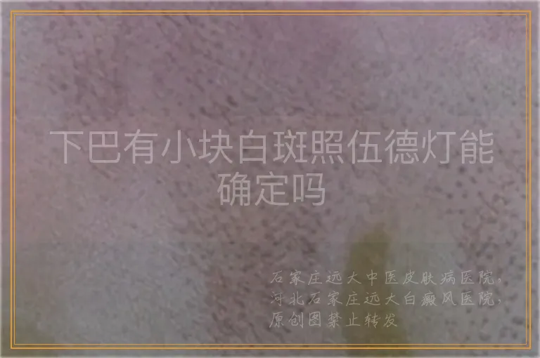 下巴有小块白斑照伍德灯能确定吗