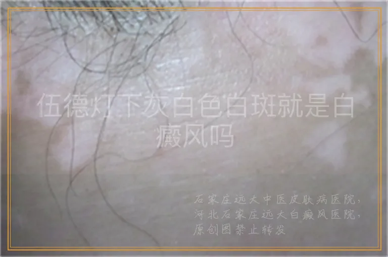 伍德灯下灰白色白斑就是白癜风吗