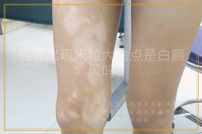后背出现米粒大白点是白癜风吗