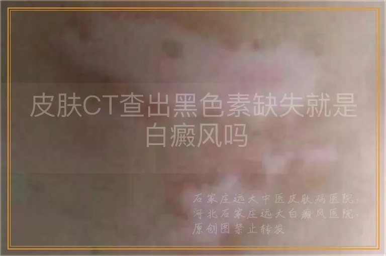皮肤CT查出黑色素缺失就是白癜风吗