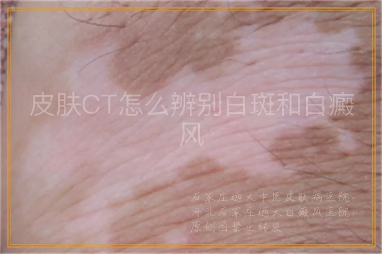 皮肤CT怎么辨别白斑和白癜风